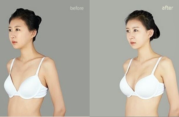 înainte și după mărirea plastică a sânilor